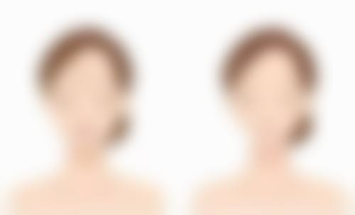 日常护理对去除痘痘的疤痕有帮助吗？