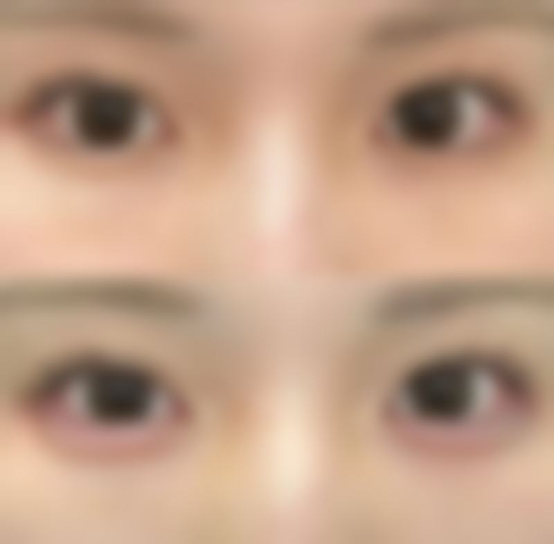 有没有一些天然的方法可以辅助去除痘痘的疤痕？