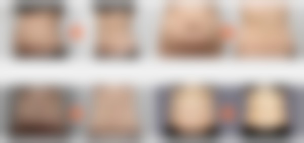 韩国365mc吸脂医院尹敬（仁川院）医生瘦大腿技术怎么样？