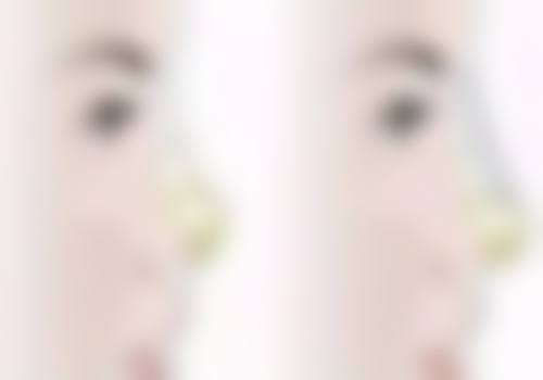 问题三:土豆片敷眼对去除眼袋有成效吗?