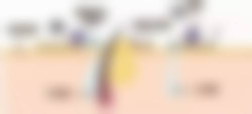 无锡第三人民医院烧伤整形科杨敏烈医生瘢痕修复技术怎么样？