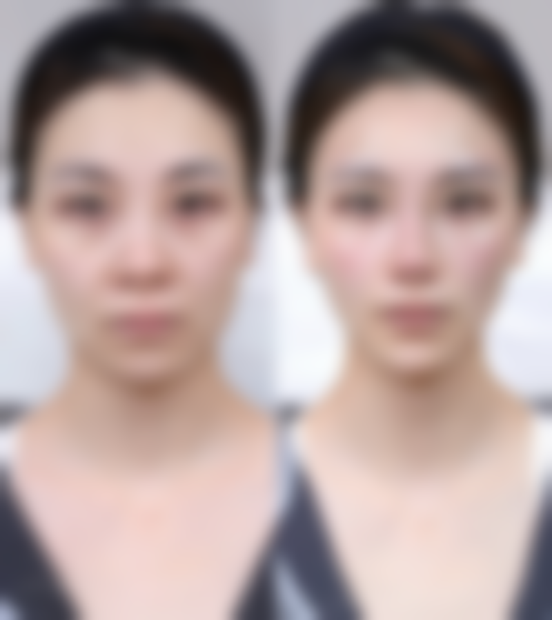 膨体和硅胶隆鼻术后修复有什么区别？