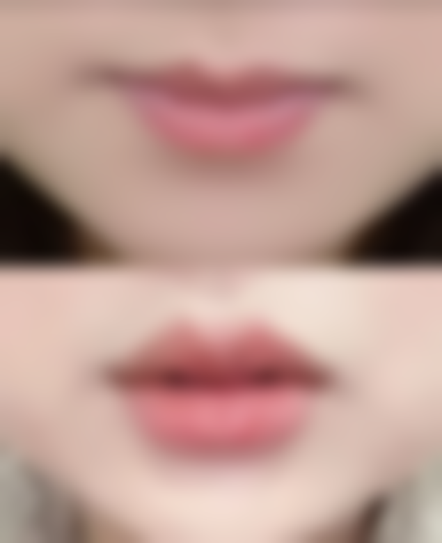 双眼皮没做好怎么办修复一只还是一双？需综合眼部基础、对称情况及个人意愿来决定