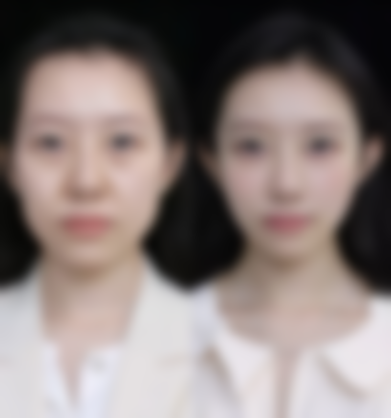 眼袋怎么去除眼袋？试试按摩、敷眼膜、手术等方法，有效改善眼部状态！ 