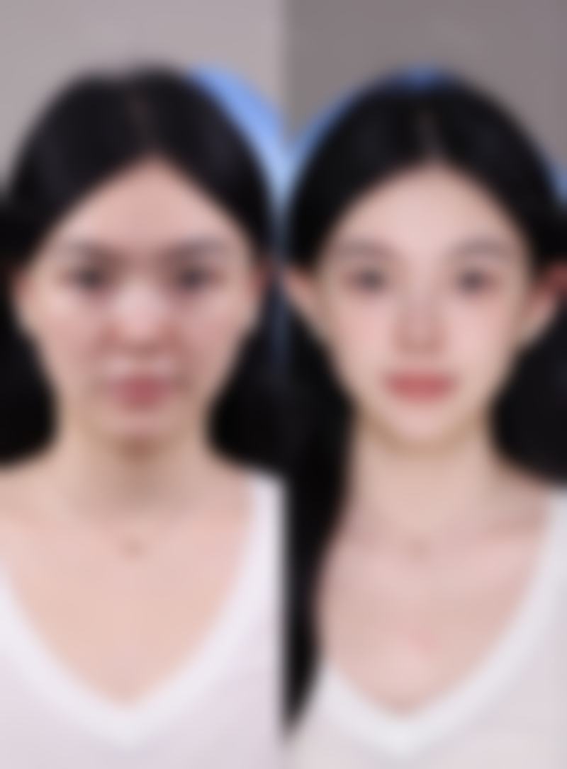 去眼袋有哪些通用注意事项？