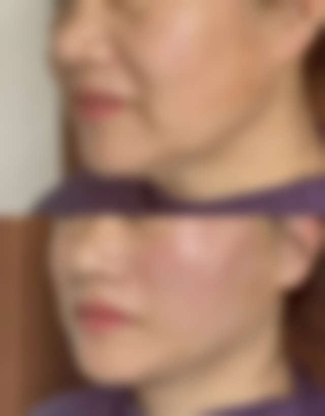 如何有效祛除黑眼圈和眼袋？试试按摩、调整作息与医美手段，你会有惊喜！ 