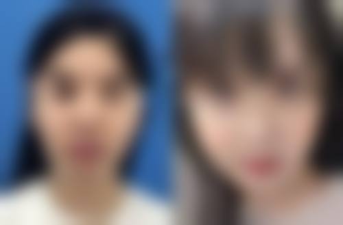 做吸脂减肥手术有哪些危害呢？可能存在感染、皮肤凹凸不平、血清肿等问题你了解吗？ 