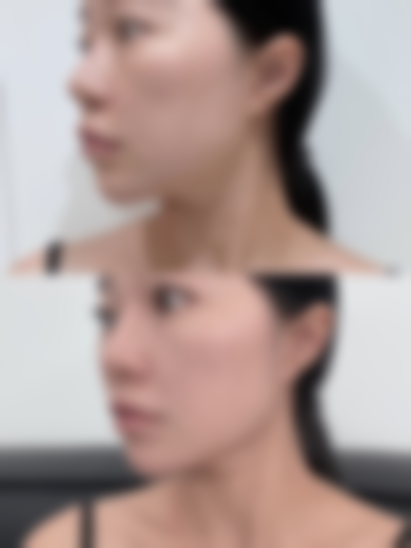 活细胞/自体细胞隆鼻有潜在风险吗?