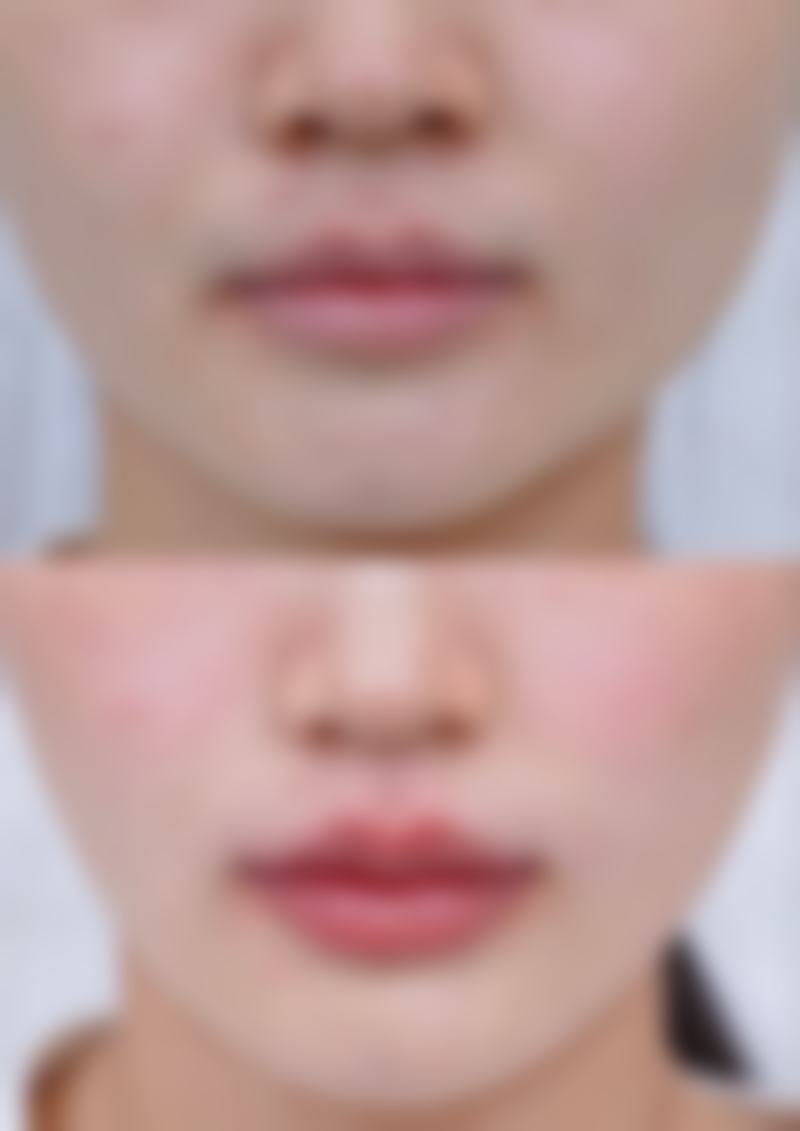 活细胞/自体细胞隆鼻会有吸收的情况吗?