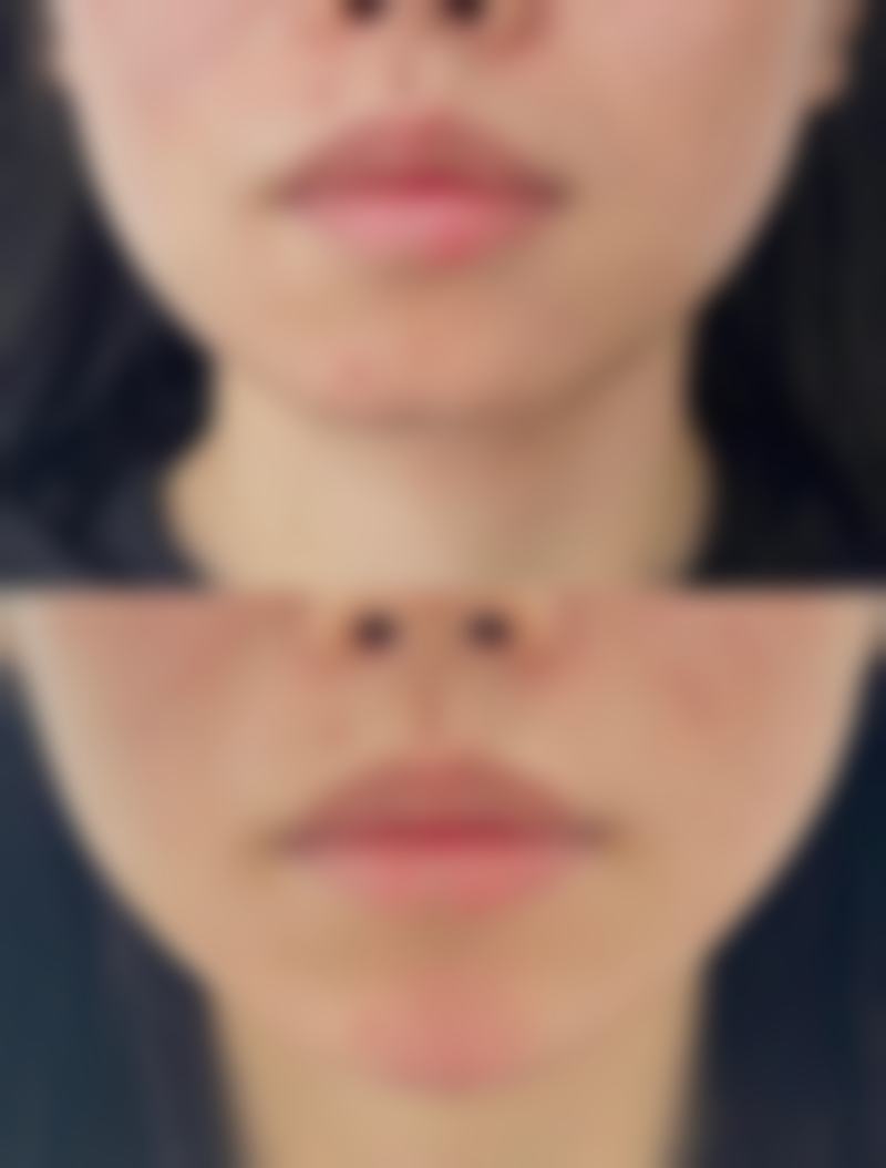 面部烫伤疤痕治疗后在生活中要注意什么呢？