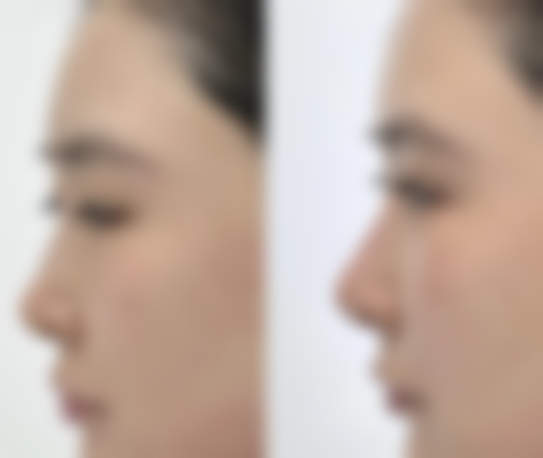 药物治疗疤痕疙瘩有哪些方式，成效如何？