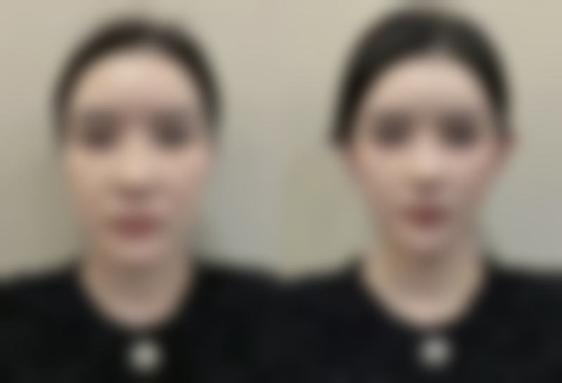 激光治疗疤痕疙瘩有哪些方式，有什么优缺点？