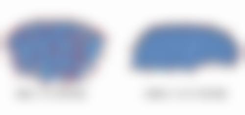 单眼皮会肿成双眼皮吗？眼部水肿成因及能否变双的科学解析来了！ 