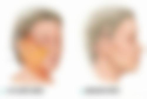 广州荔湾区肤康皮肤科医院整形科卢植生医生痤疮治疗技术怎么样？