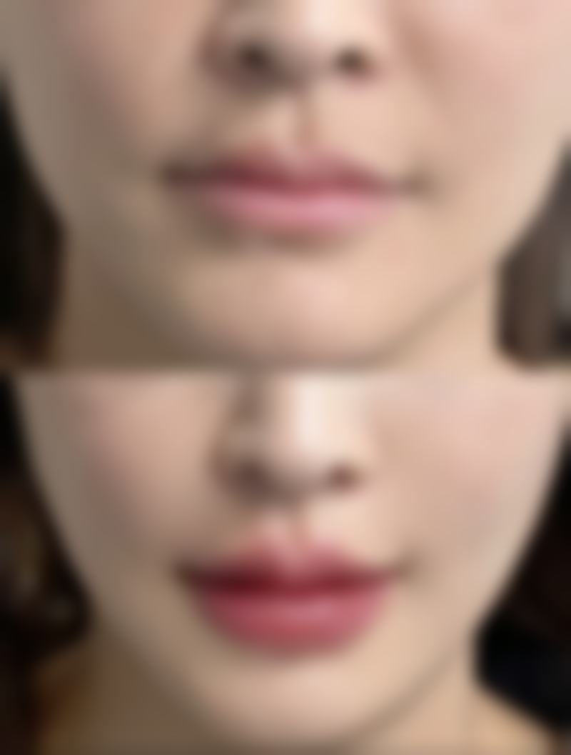 哪些生理性因素会让单眼皮肿成双眼皮？