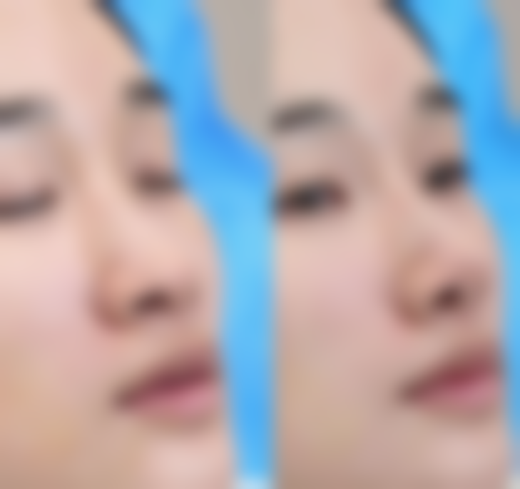 浓缩脂肪丰胸术的浓缩脂肪是如何定义和制备的？手术原理又是什么？