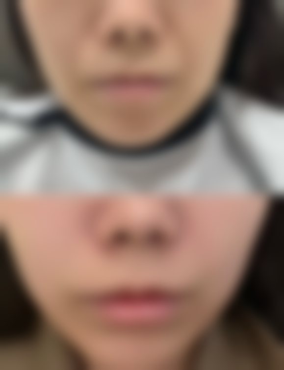 林沸腾隆胸术的原理和术中优势是什么？