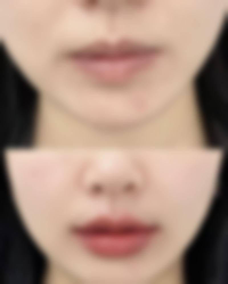 生理性肿胀导致的单眼皮变双眼皮能修复吗？