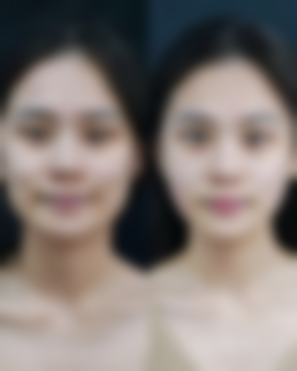 双眼皮术后眼睛怕光是怎么回事？可能是炎症刺激、角膜损伤还是其他原因导致的？ 