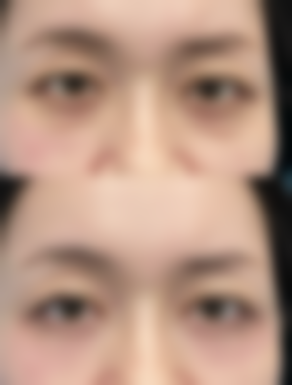 手术治疗面部凹陷疤痕有哪些方式？