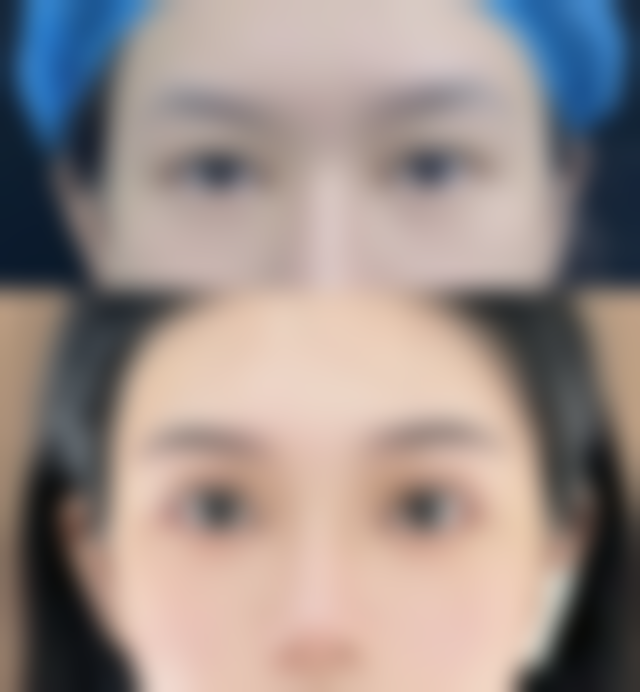 治疗面部凹陷疤痕的费用大概是多少？