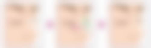 假体隆胸后需要趴床多久？一般来说1 - 3个月，具体时长还得看个人恢复情况 