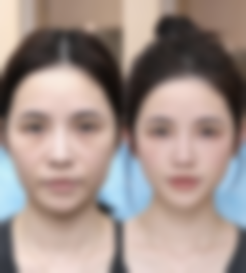 除了手术和填充，还有其他改善方式吗？