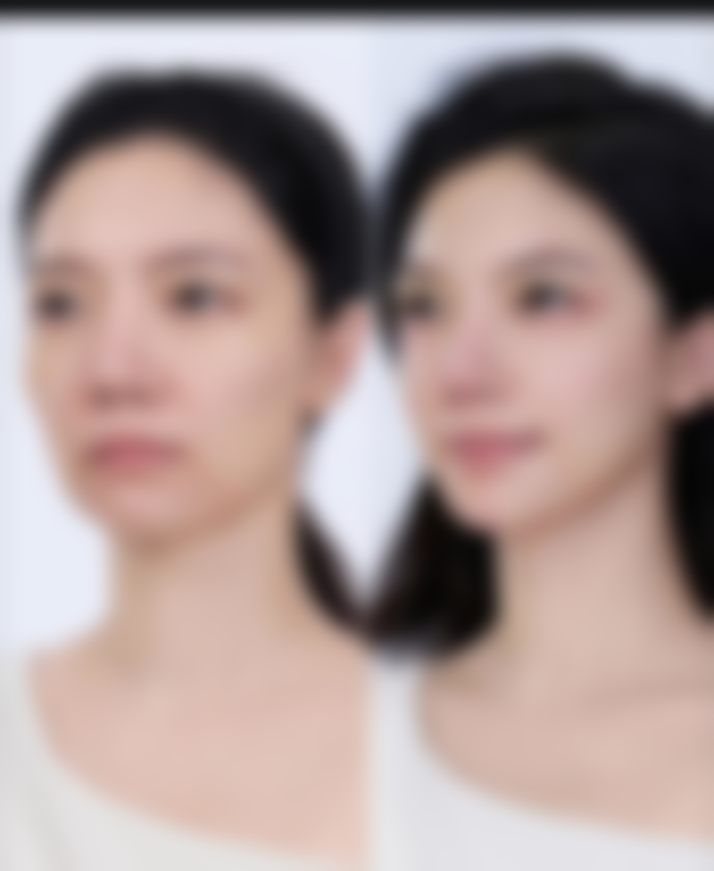 通用假体隆胸术后趴床时间有统一标准吗？