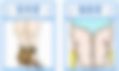 激光去眼袋有哪些优势？