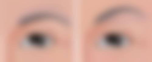 激光怎样去除眼袋？利用热效应汽化、收缩脂肪和组织，轻松告别眼袋烦恼！ 