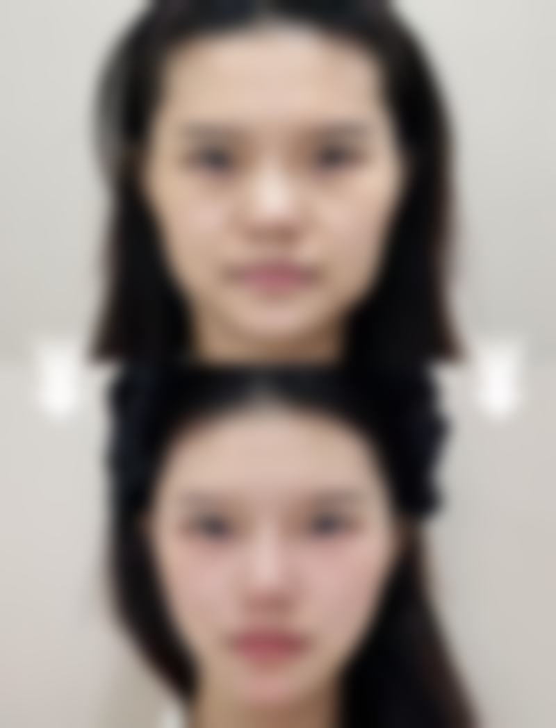 选择好的瘦脸针牌子就能确保瘦脸成效吗？