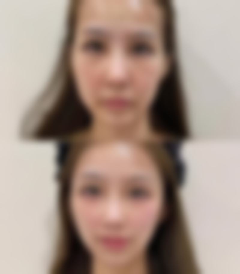 衡力作为瘦脸针牌子怎么样？