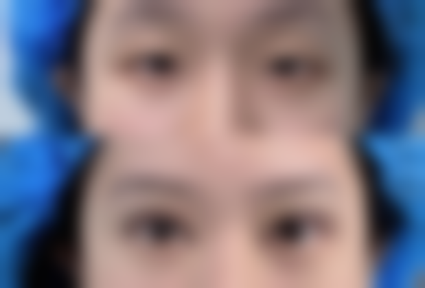 激光去眼袋的操作流程是怎样的？