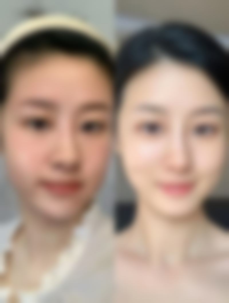 Botox瘦脸针单次成效能维持多久？