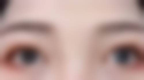 做了隆鼻手术有什么后遗症？感染、移位、排异等情况会出现吗？ 