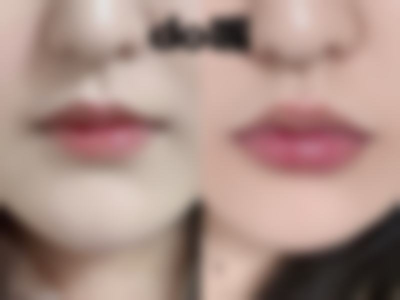 为什么会有人说植发几年后又掉了呢？