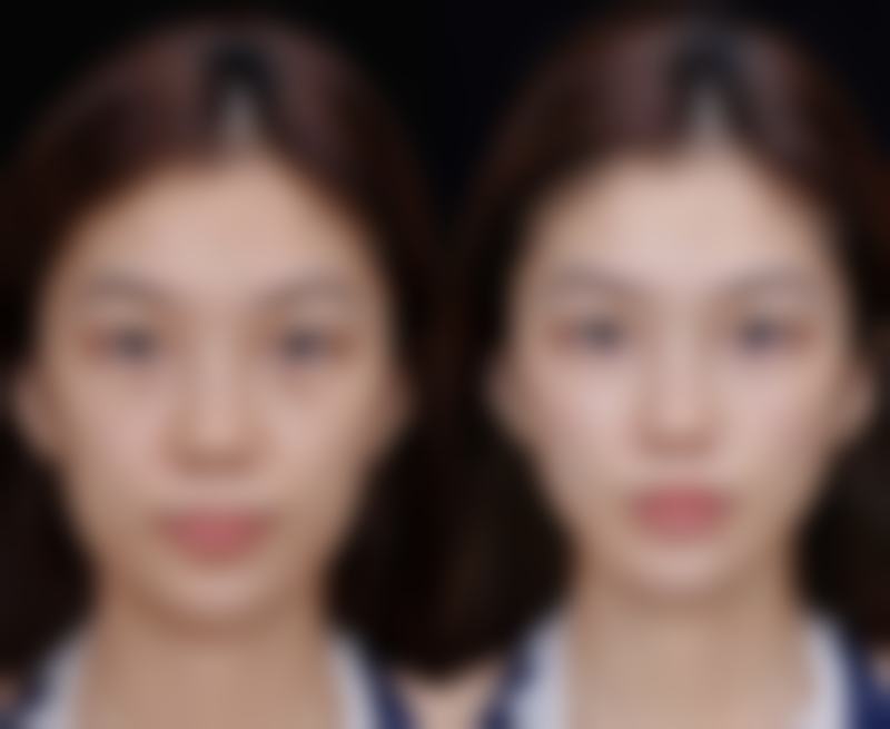 隆鼻手术哪种最好最安全？膨体隆鼻、硅胶隆鼻和自体软骨隆鼻各有优势！ 