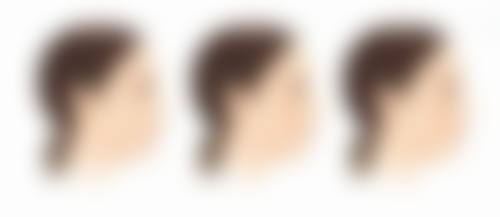 运城丽霞医疗美容诊所姚丽霞医生仿真双眼皮技术怎么样？