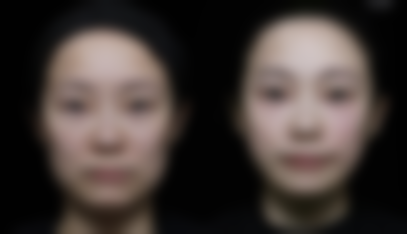 外切眼袋专属正常术后现象是怎么让皱纹增多的？