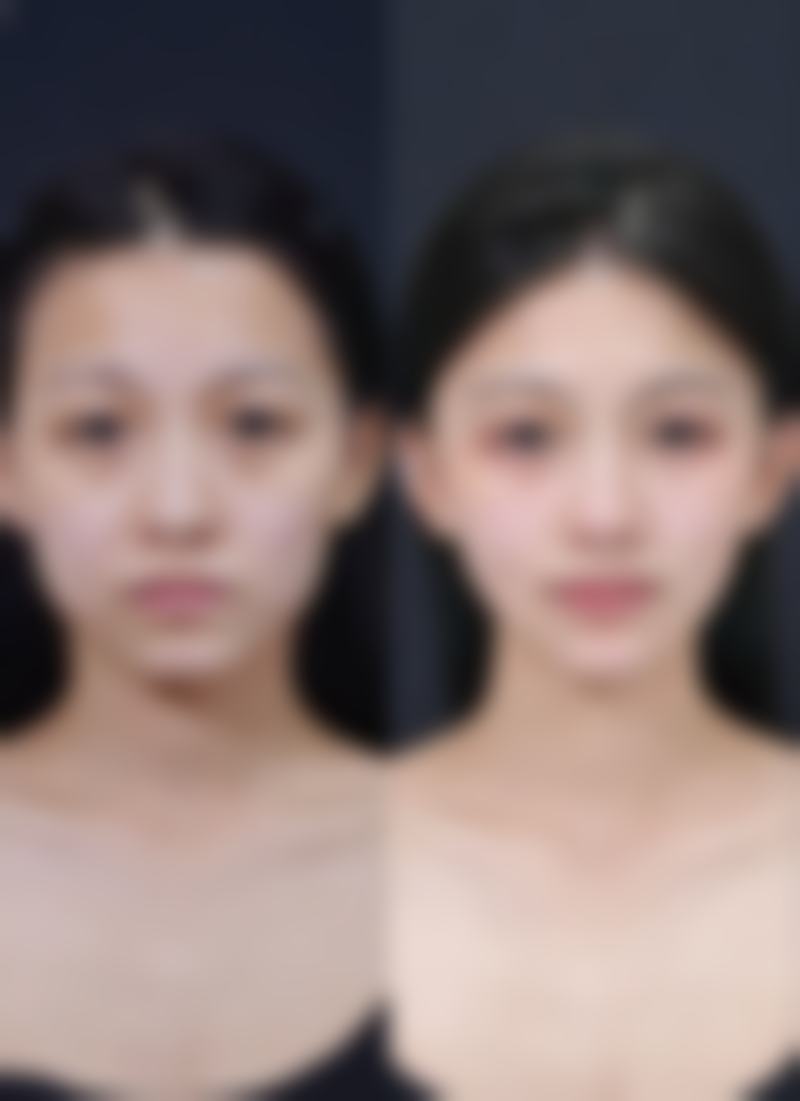 手术操作/技术问题会引起切完眼袋后皱纹增多吗？