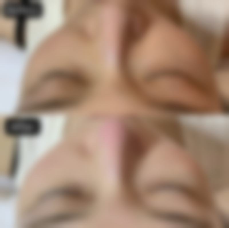 物理治疗烫伤疤痕有哪些方式呢？