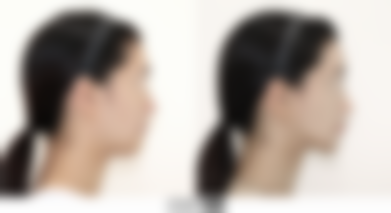 广州壹加壹整形美容医院姚文波医生手术缩鼻头技术怎么样？