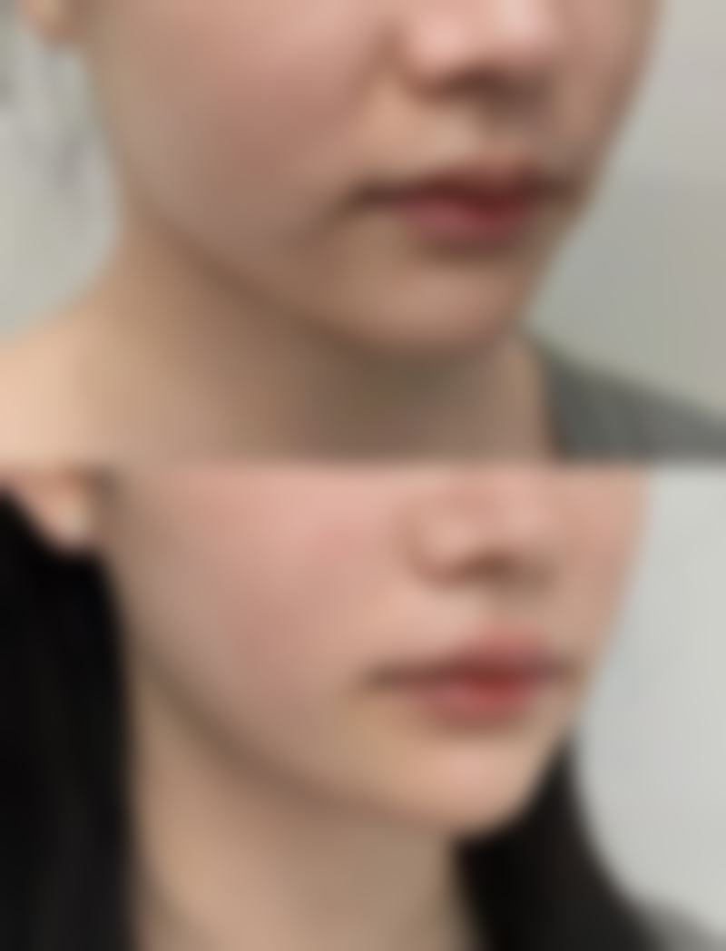 怎样有效去除烫伤疤痕？按摩、药物、激光治疗等方法能否带来理想效果？ 