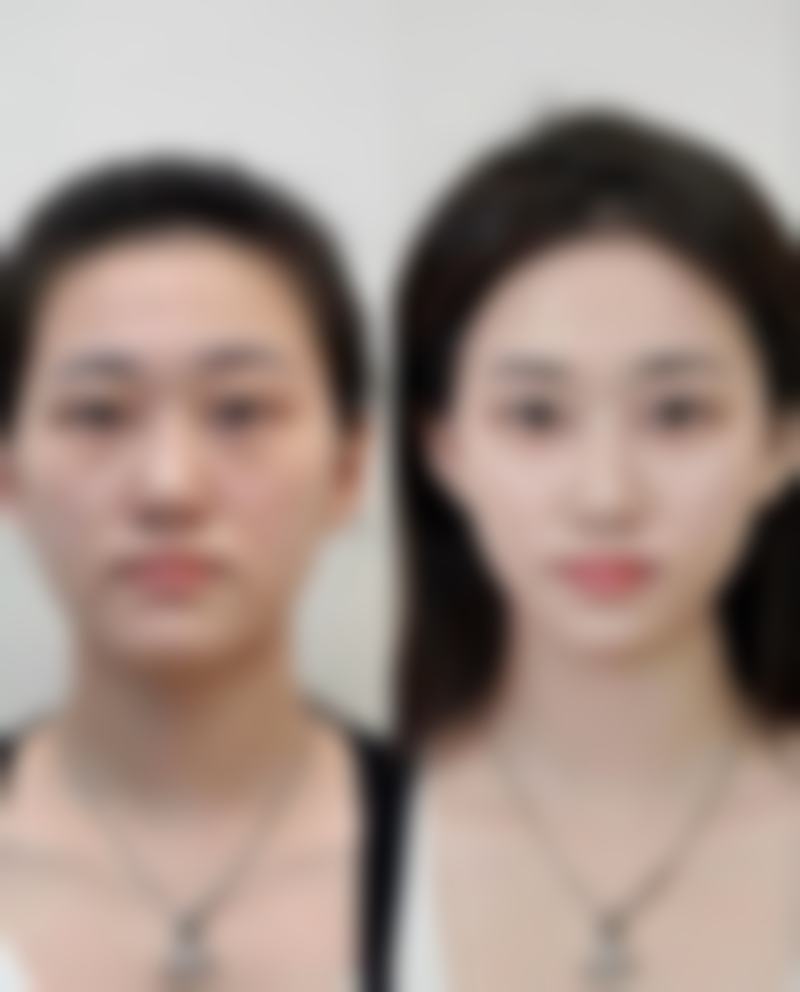 日常护理对消除脸上缝针疤痕重要吗？