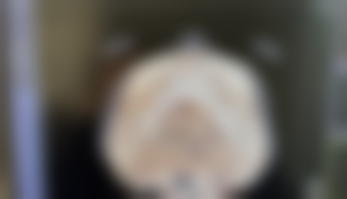 药物治疗能消除脸上缝针疤痕吗？