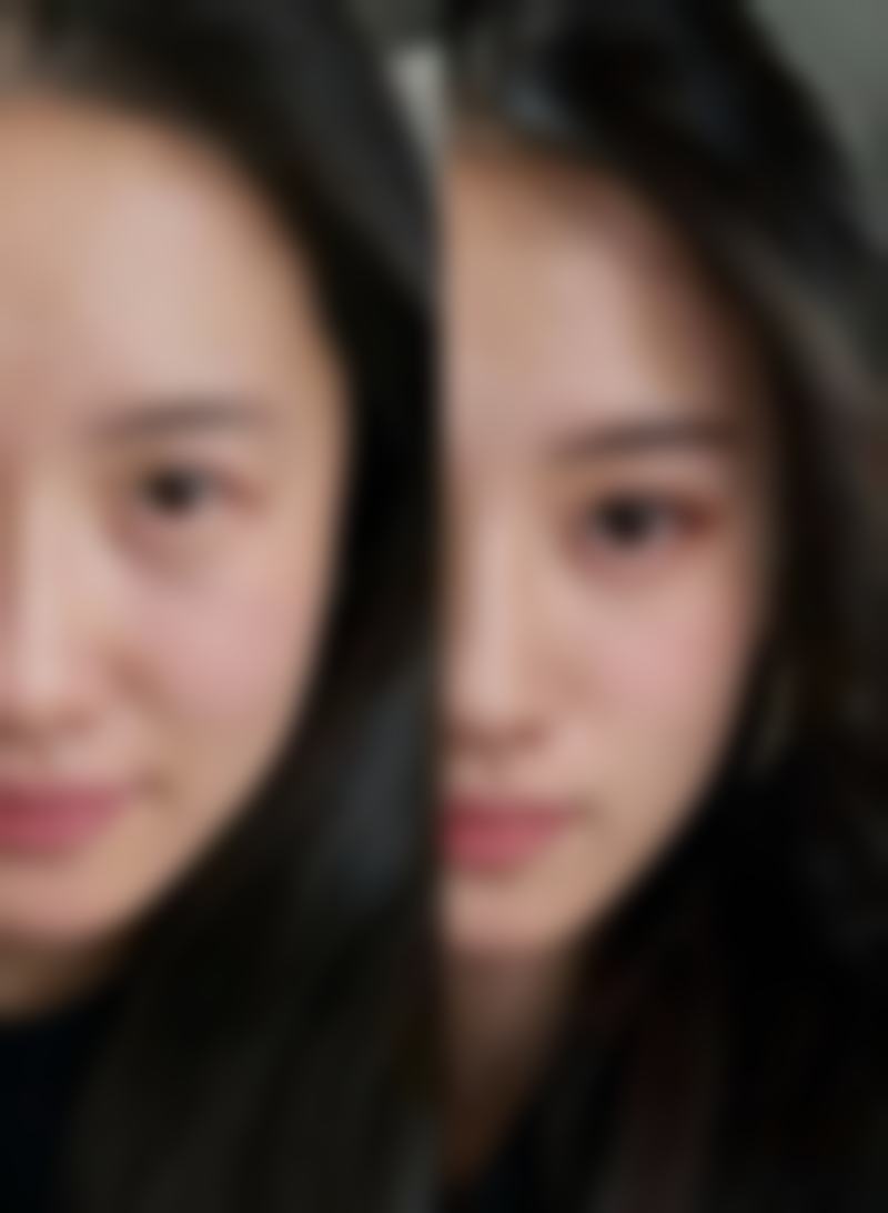 综合治疗烫伤疤痕有成功实例吗？