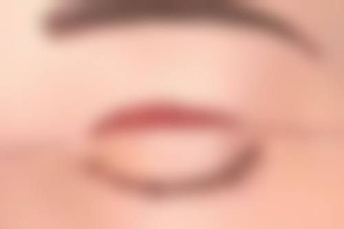 点痣留下的疤痕增生能去掉吗？答案是肯定的，多种方法助你有效消除疤痕！ 