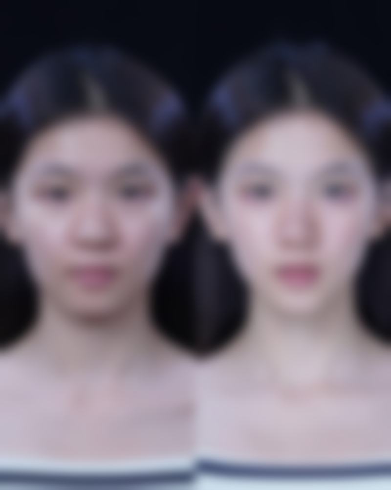 面部吸脂有哪些典型的手术技术实例？