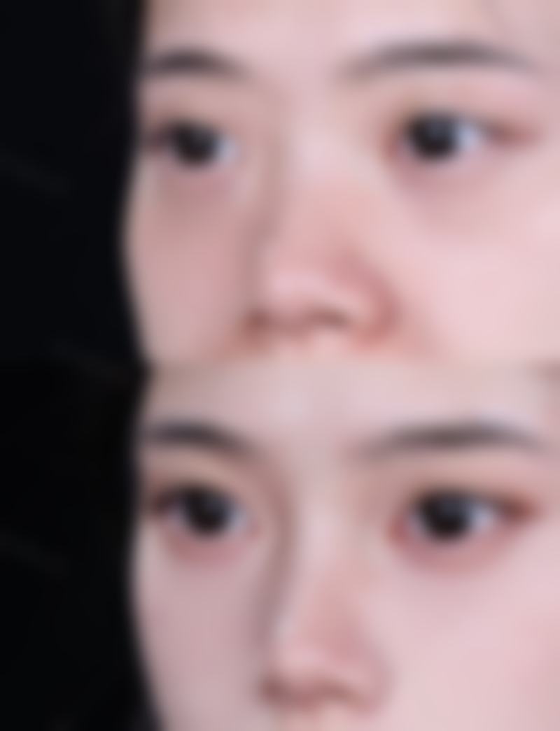 无锡第三人民医院烧伤整形科朱宇刚医生自体脂肪丰臀技术怎么样？