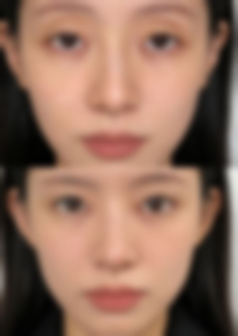 头发种植单价多少？受种植技术、毛囊数量、医院资质等因素影响差异大！ 